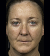 Fraxel Face Treatment Gallery3